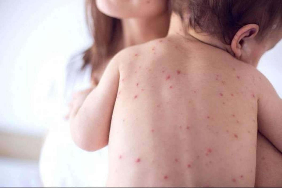 В Армении растет число заболевших корью