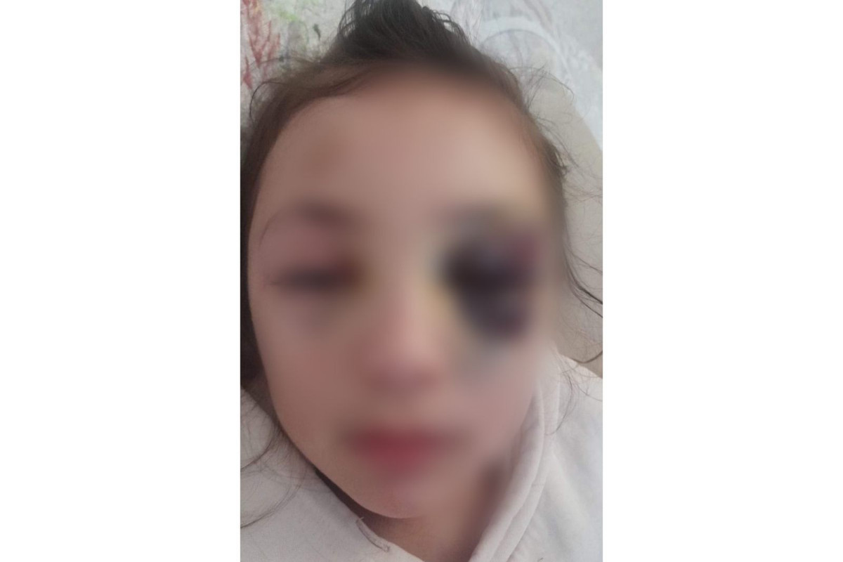 Прокуратура расследует факт телесного повреждения школьницы в Баку