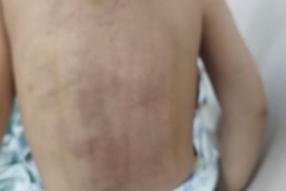 В Лянкяране отчим избил трехлётнего ребенка, начато расследование